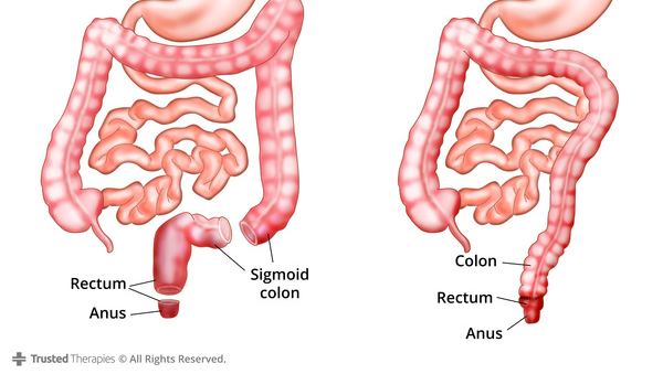 Surgery for Crohn's Disease (Abdominal/Intestinal) - Trust Pharmacy
