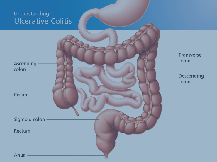 Understanding ulcerative colitis